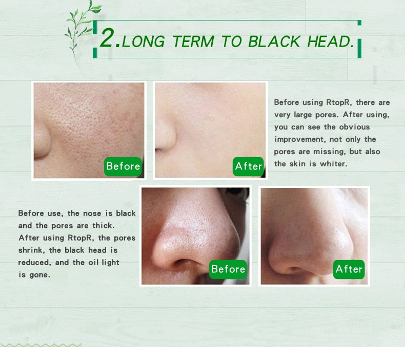 Mango Blackhead Remover Acne Treatment